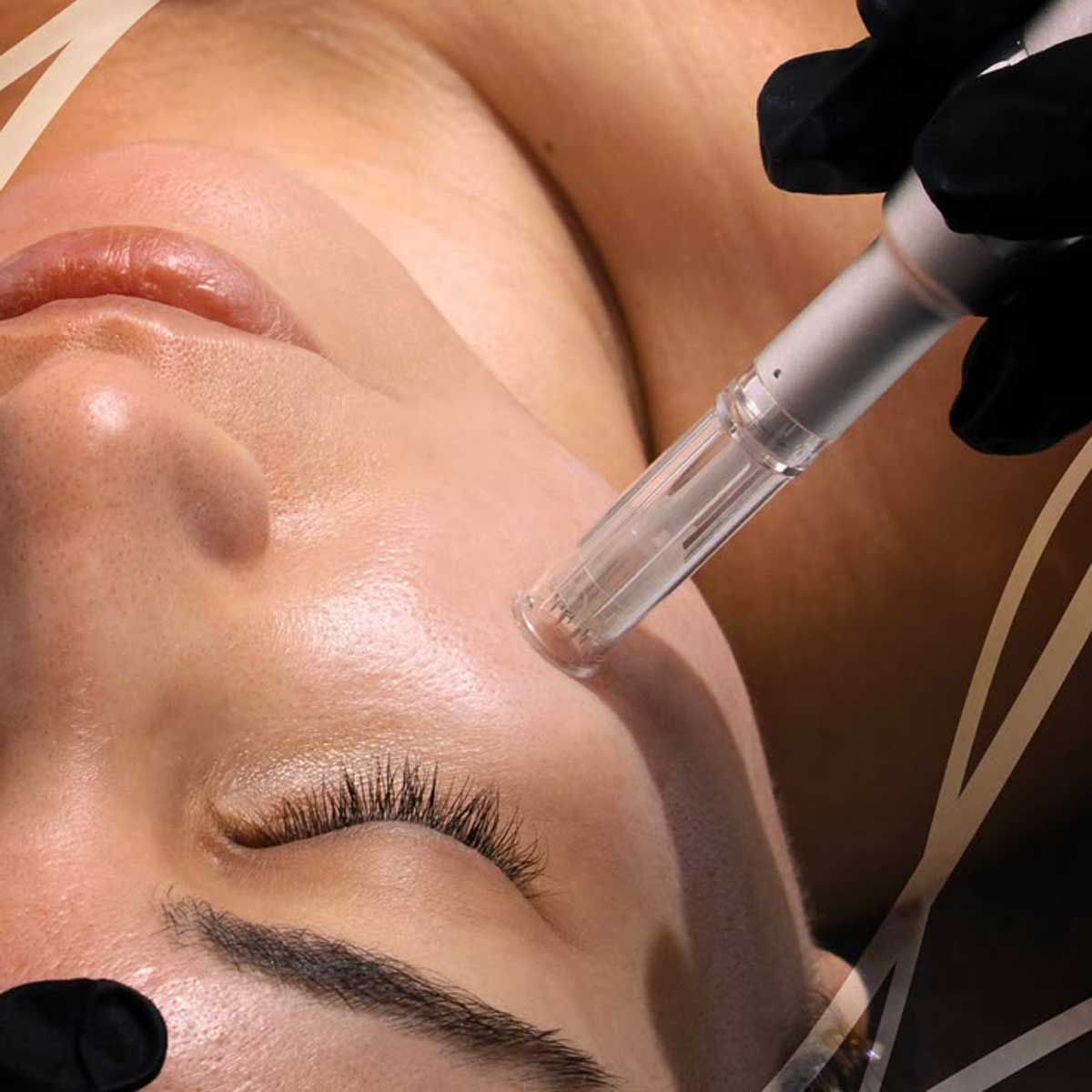 Microneedling-01
